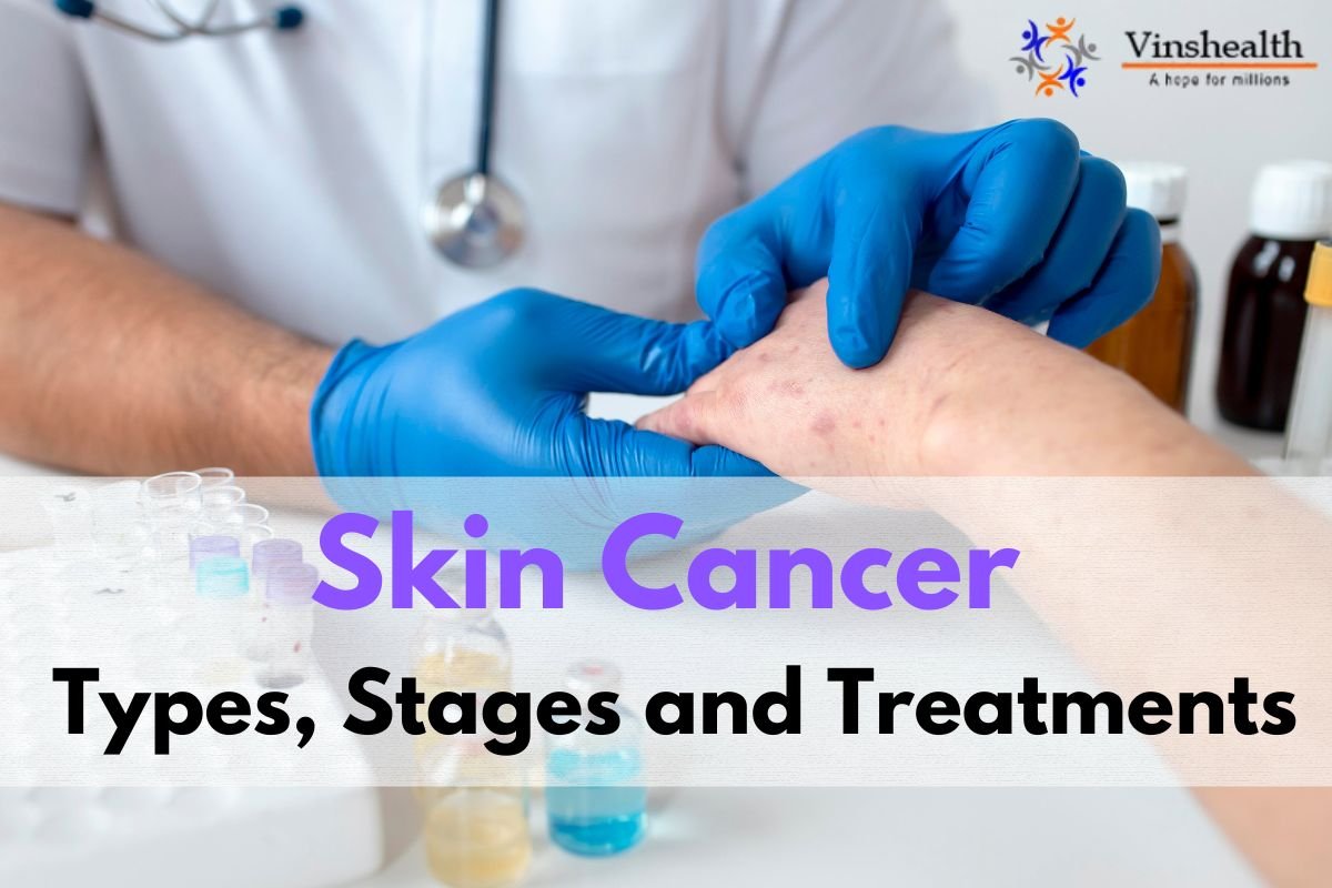 Skin Cancer: Types, Stages and Treatments