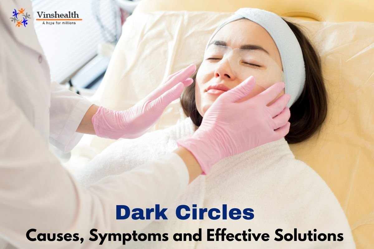Dark circles under the eyes: Causes  and Symptoms