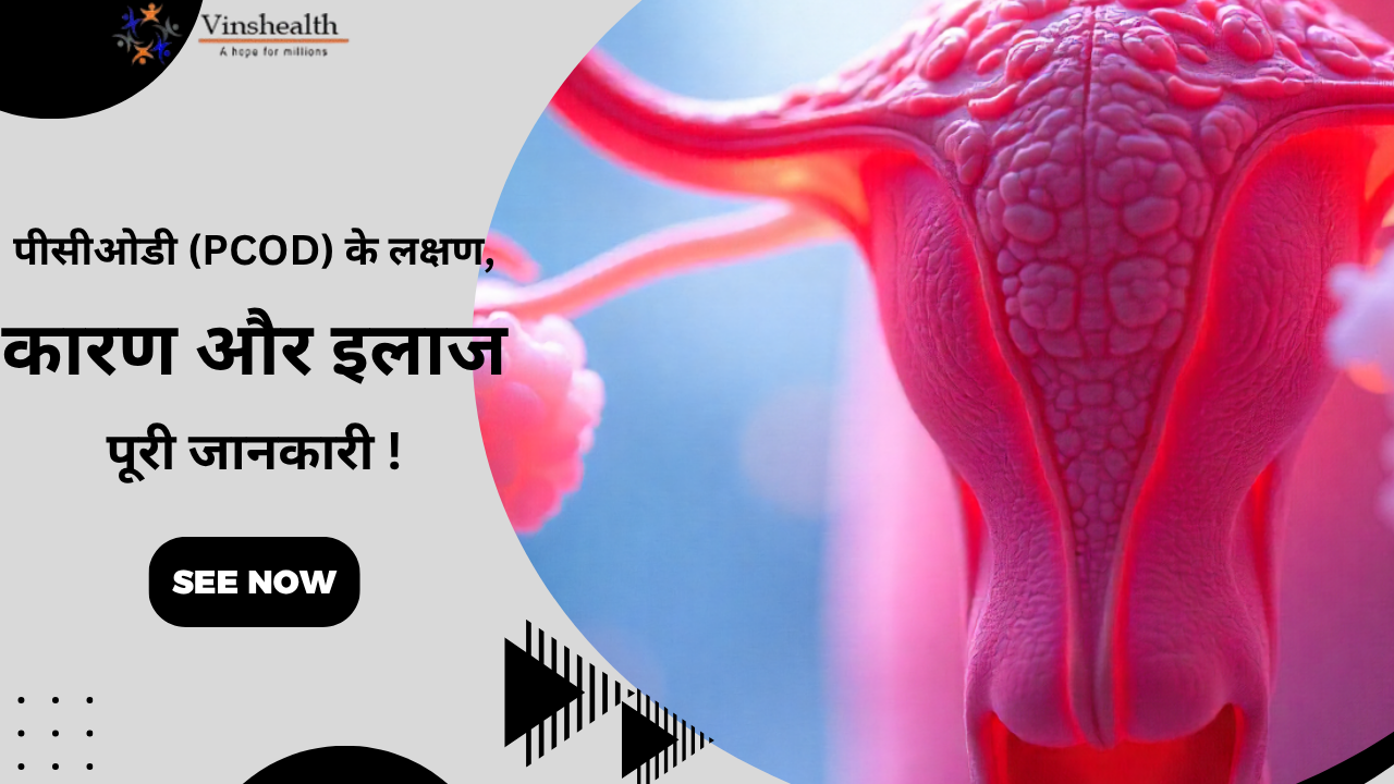 पीसीओडी (PCOD) के लक्षण, कारण और असरदार उपचार – पूरी जानकारी!