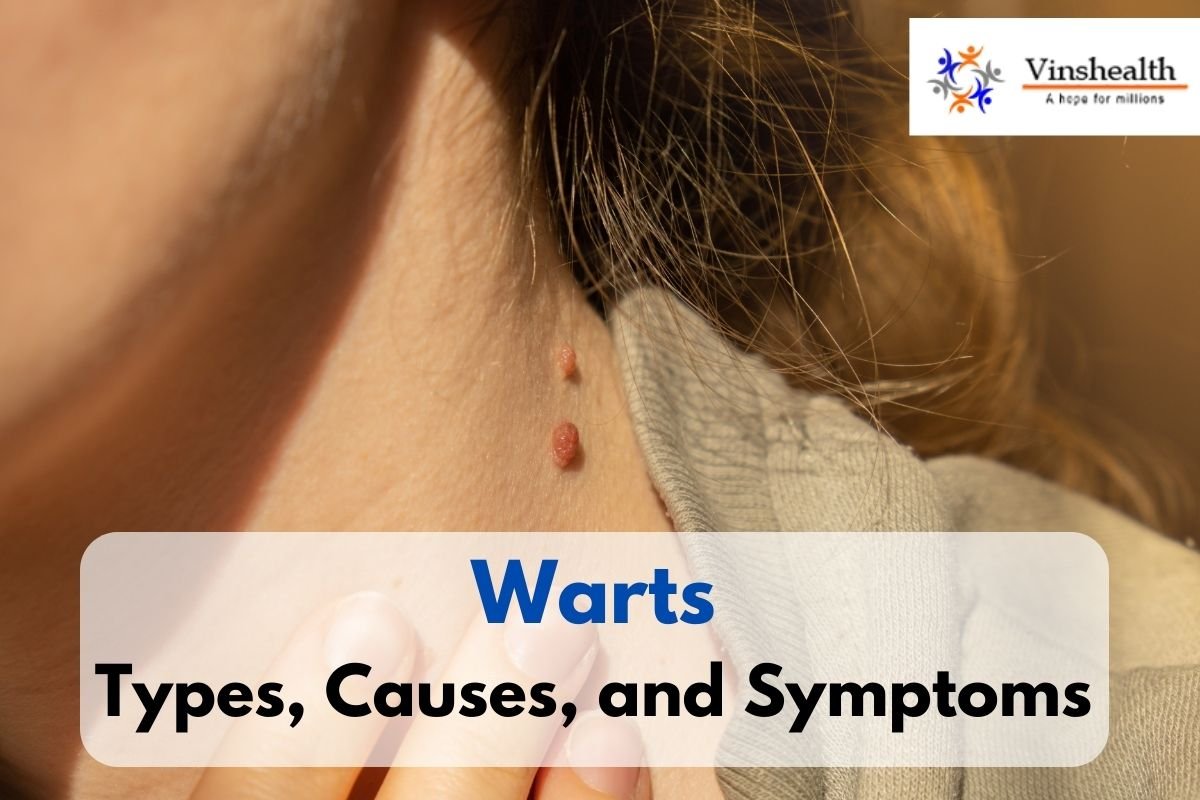 Dermatologist In Delhi For Wart Removal Treatment