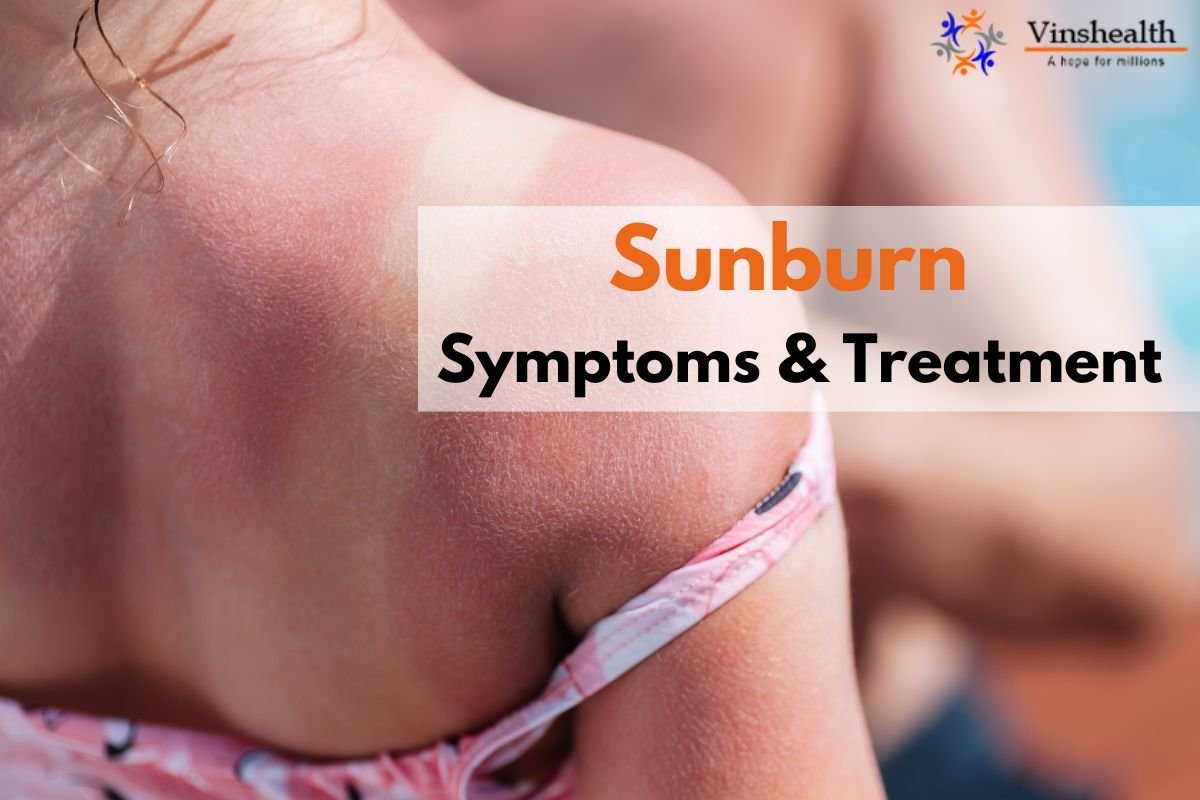 Sunburn: Symptoms & Treatment