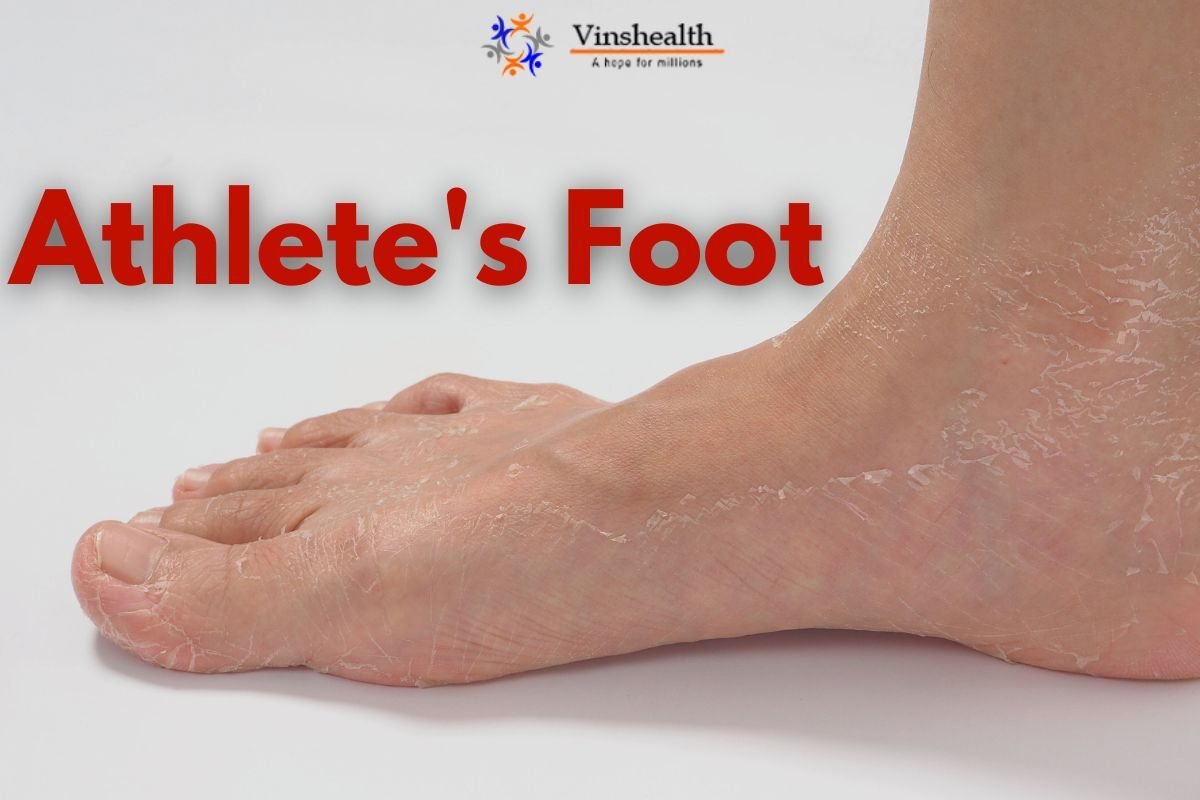 Athlete's Foot: Causes and Symptoms