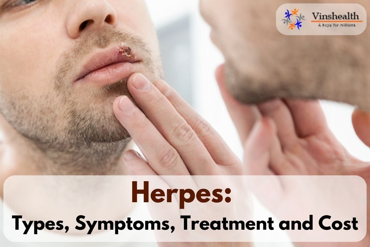 Herpes: Types, Symptoms, Treatment and Cost