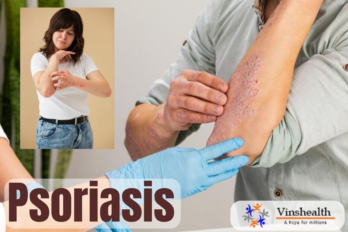 Psoriasis: Causes, Symptoms and Treatment