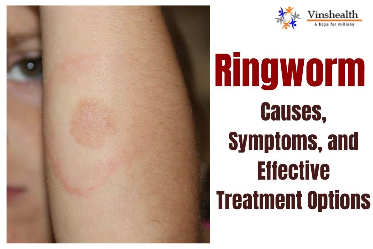 Ringworm: Causes, Symptoms and Treatment