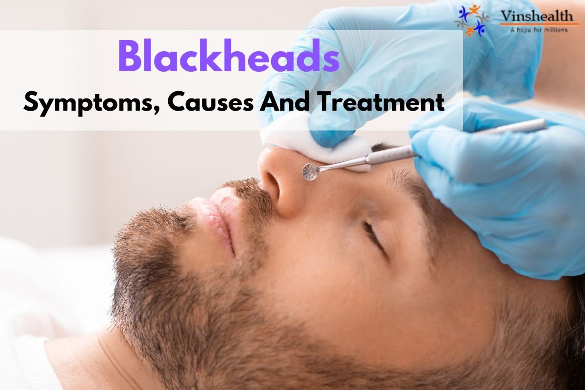 Blackheads: Symptoms, Causes And Treatment