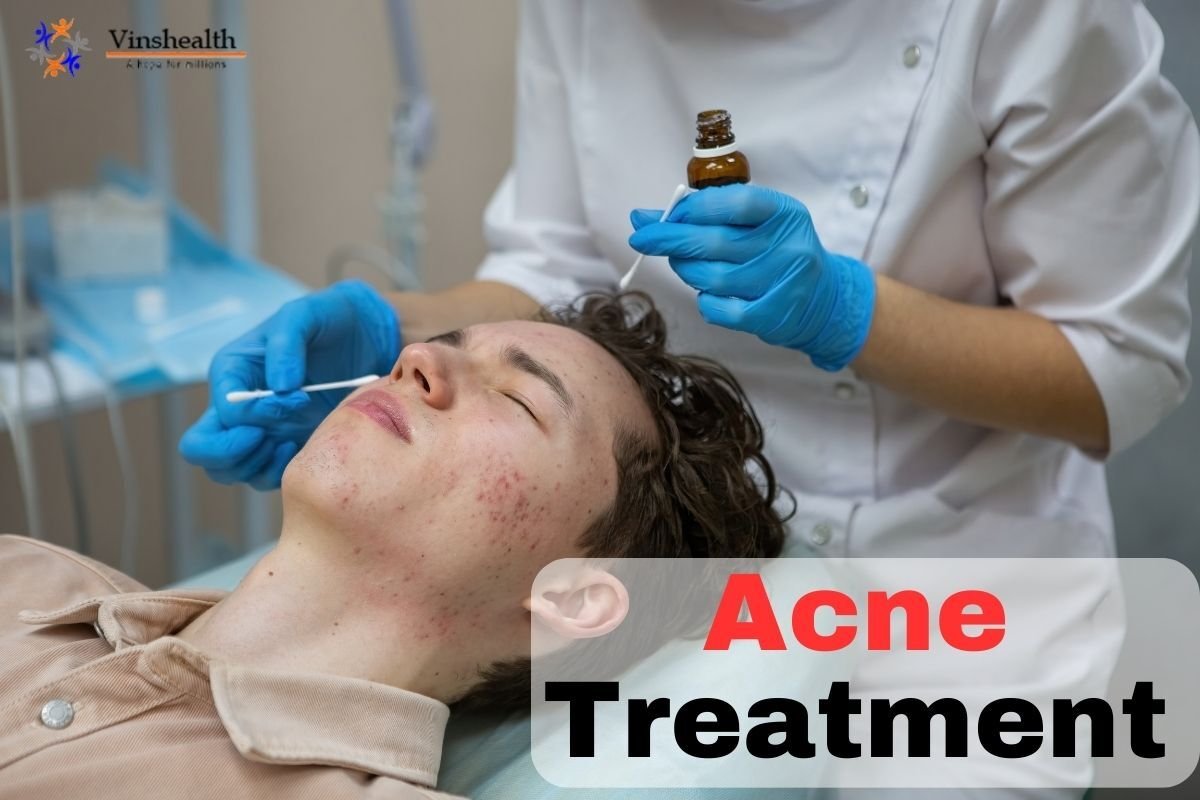 Acne Treatment: Causes, Symptoms and cost