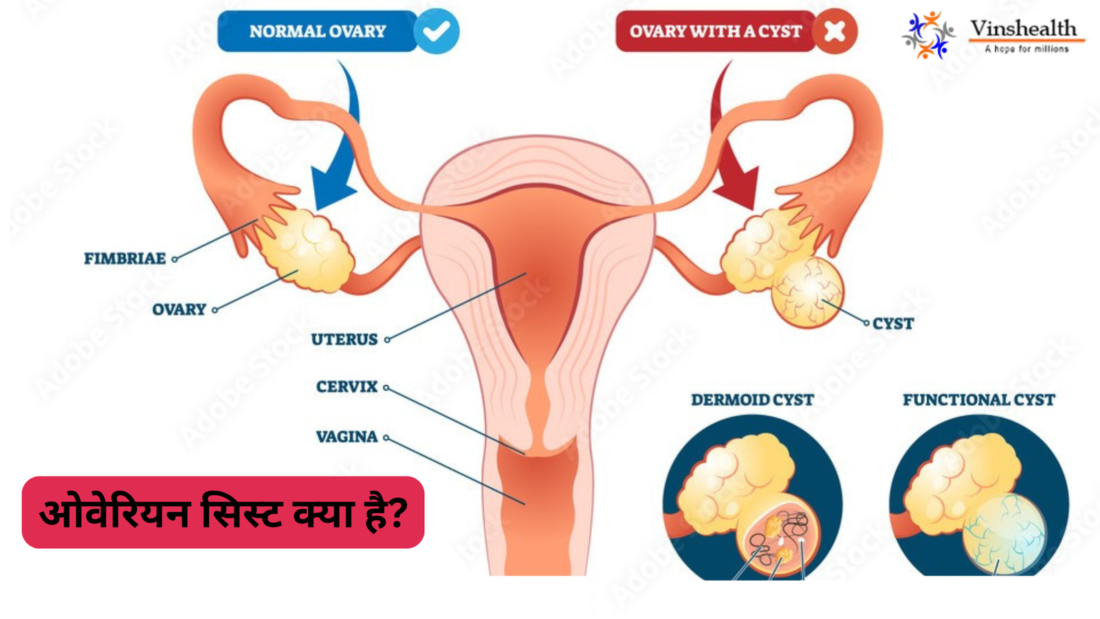 ओवेरियन सिस्ट क्या है?