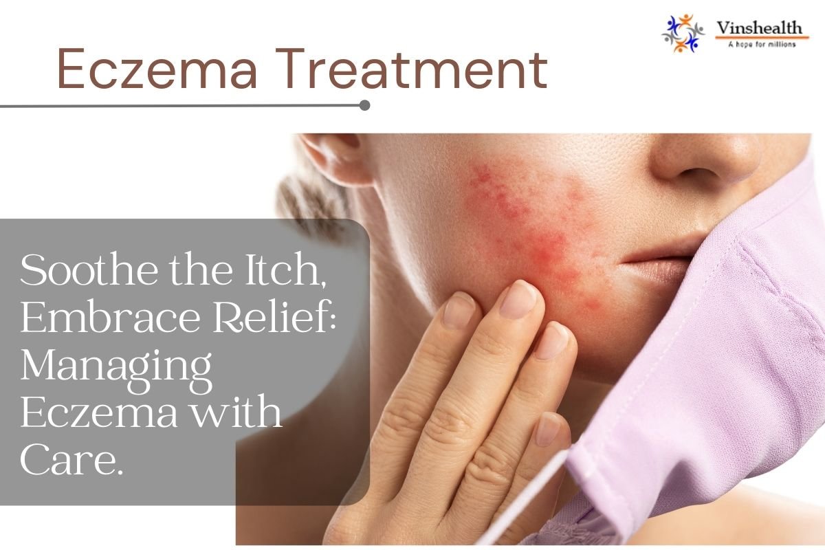 Best Eczema Specialist Doctor in Delhi