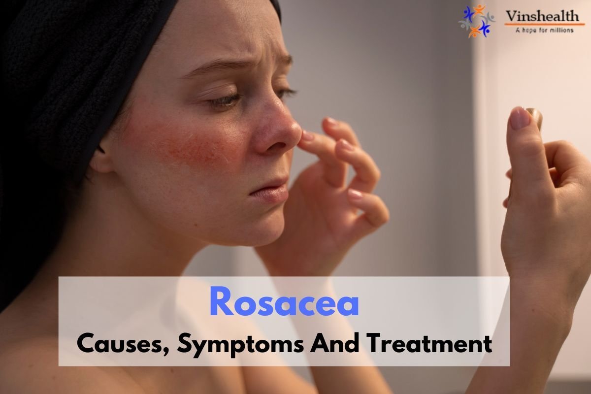 Rosacea: Causes and Treatment