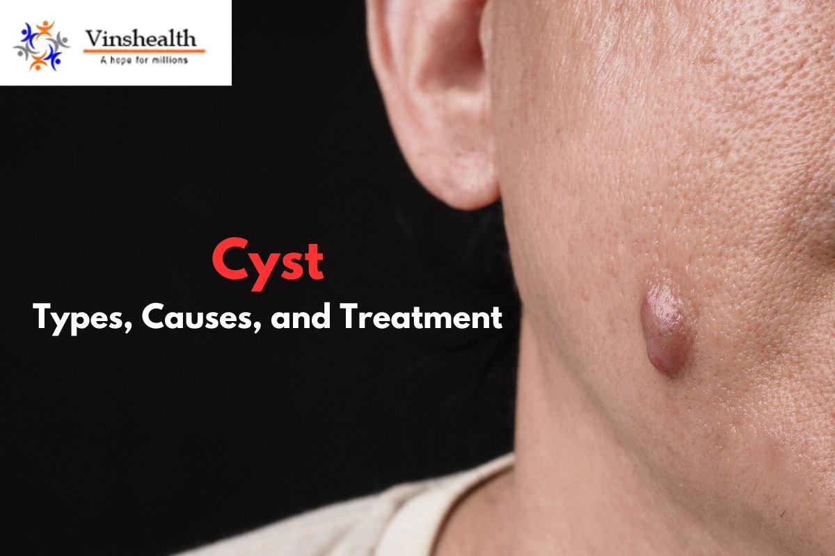 Cyst: Types, Causes, And Treatment